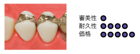 パラジウムインレー