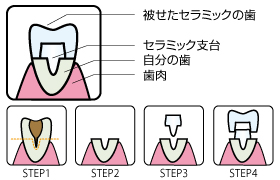 オールセラミック