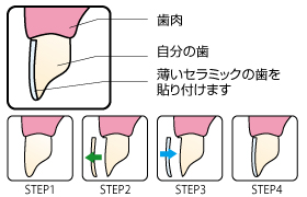 ラミネートベニア
